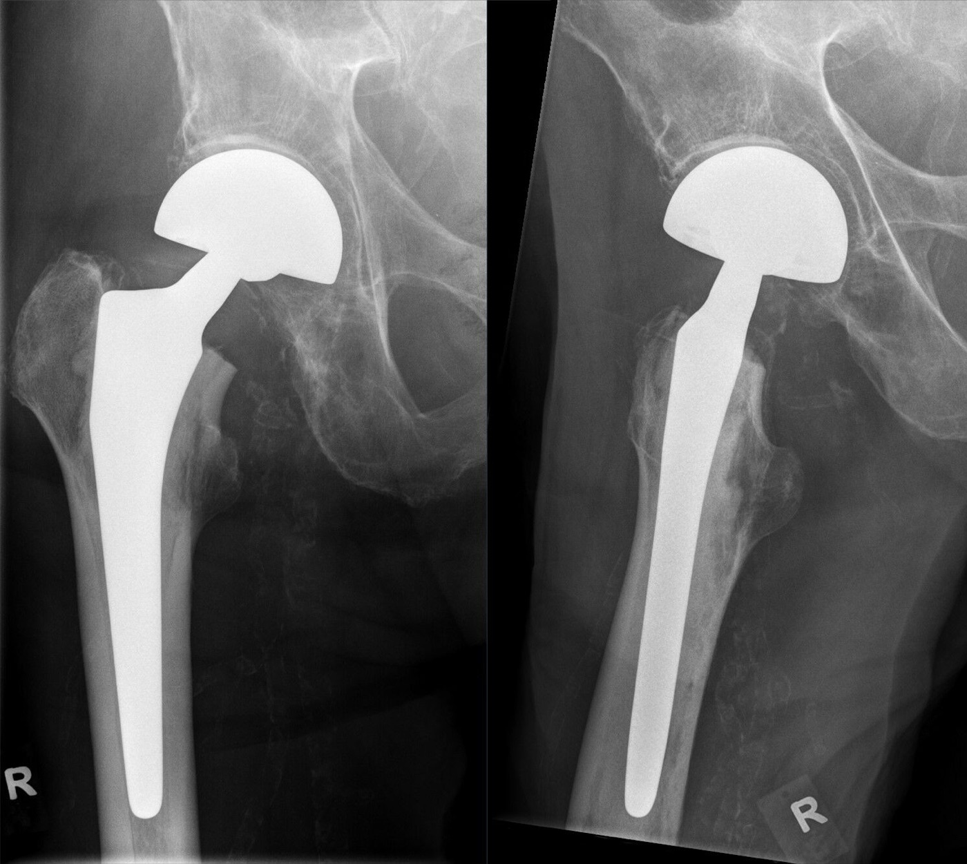 Figure 9. A bipolar hemiarthroplasty of the right hip, two projections. Hellerhoff, CC BY-SA 4.0, via Wikimedia Commons.