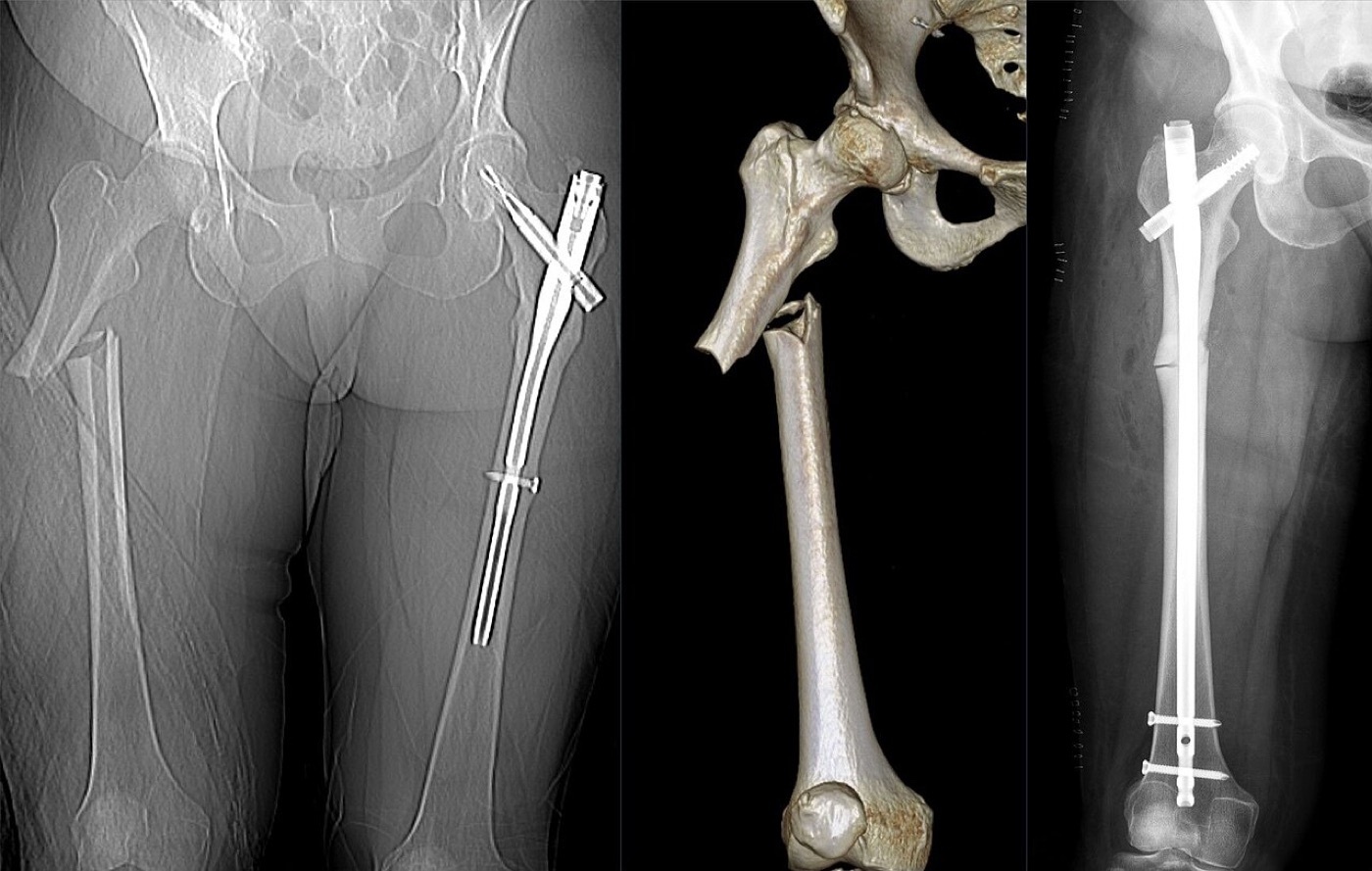 Figure 12. A femoral fracture before fixation, on 3D CT reconstruction, and after intramedullary nailing (post-operative radiograph). Image by Hellerhoff, CC BY-SA 4.0, via Wikimedia Commons.