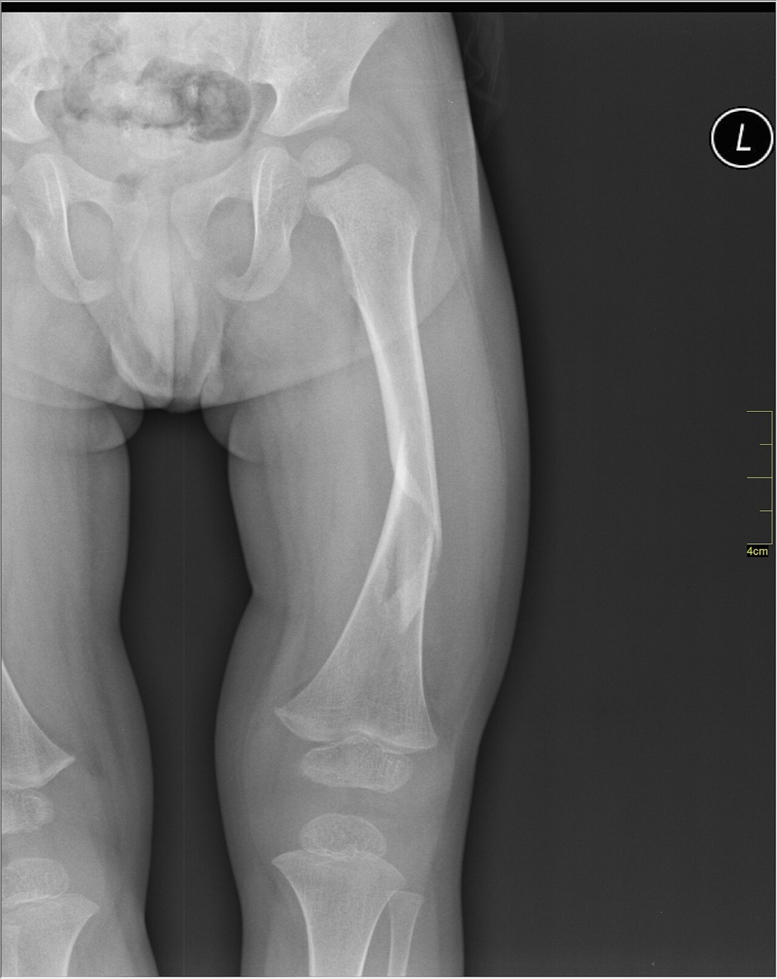 Figure 14. Paediatric transverse fracture of the femoral shaft with open growth plates, AP radiograph. Image by Nevit Dilmen, CC BY-SA 3.0, via Wikimedia Commons.
