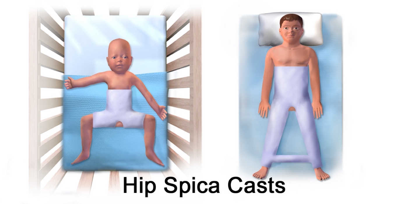 Figure 15. Hip spica casts, used for femoral shaft fractures in young children. Illustration by BruceBlaus, CC BY-SA 4.0, via Wikimedia Commons.