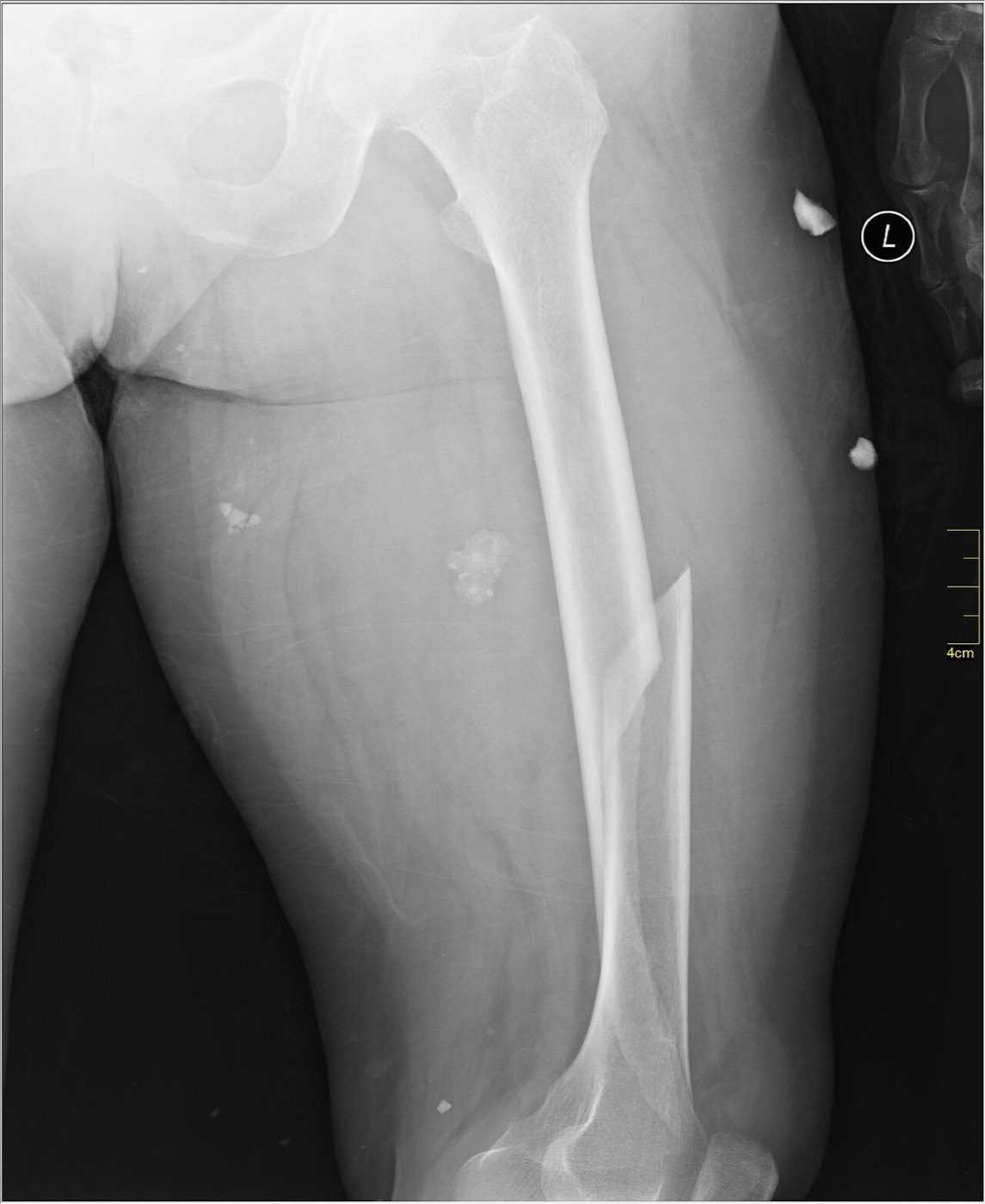 Figure 5. Displaced oblique/spiral fracture of the femoral shaft, AP radiograph. Image by Nevit Dilmen, CC BY-SA 3.0, via Wikimedia Commons.
