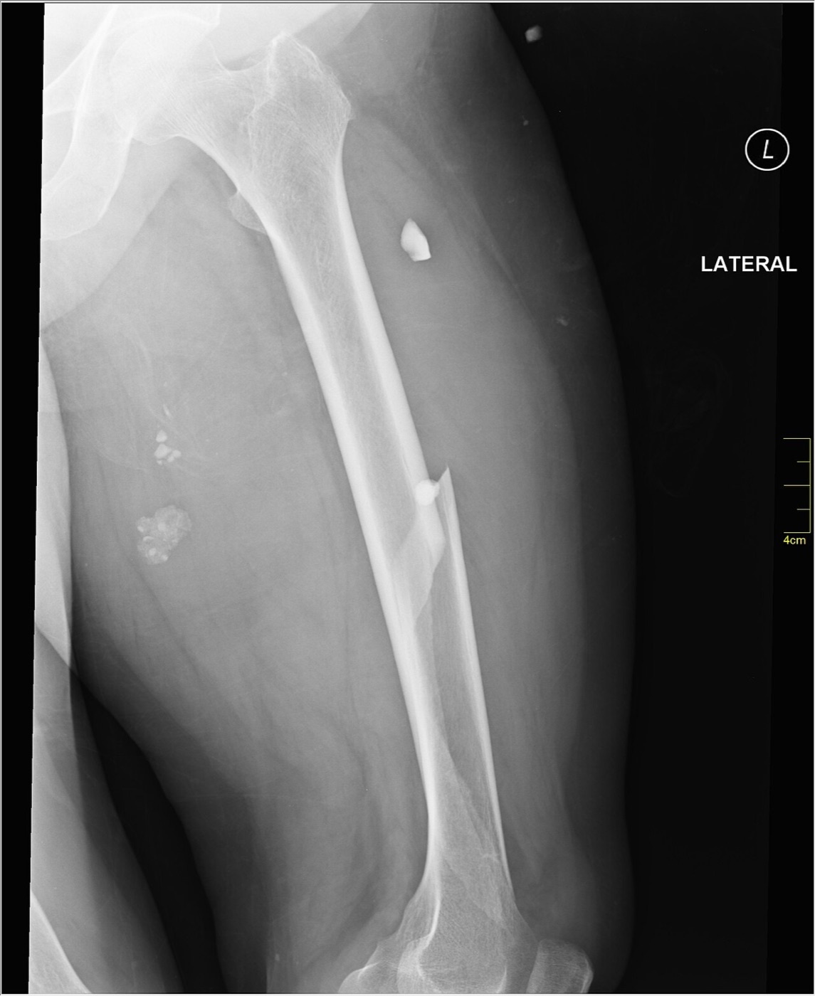 Figure 6. The same femoral shaft fracture on the lateral radiograph, confirming displacement in two planes. Image by Nevit Dilmen, CC BY-SA 3.0, via Wikimedia Commons.