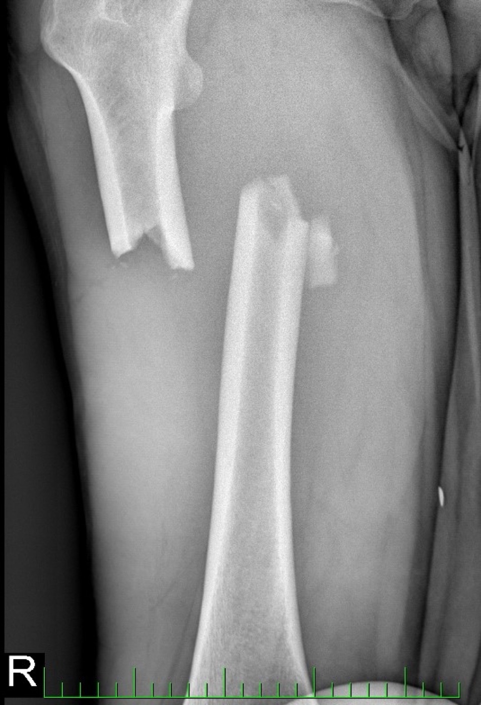 Figure 7. Displaced transverse/short-oblique fracture of the proximal femoral shaft. Image by Marek2kkk, CC BY-SA 4.0, via Wikimedia Commons.