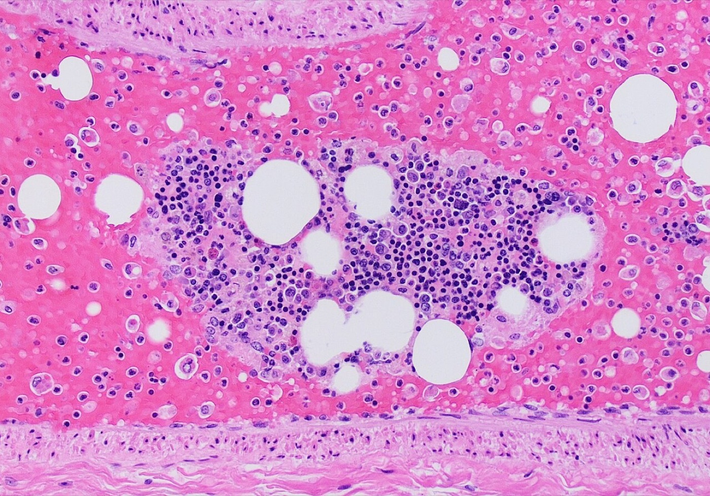 Figure 8. Pulmonary fat embolism: a pulmonary artery containing fat vacuoles together with a bone-marrow fragment (H\&E), a systemic complication of long-bone fractures. Image by Mikael Häggström, CC0, via Wikimedia Commons.