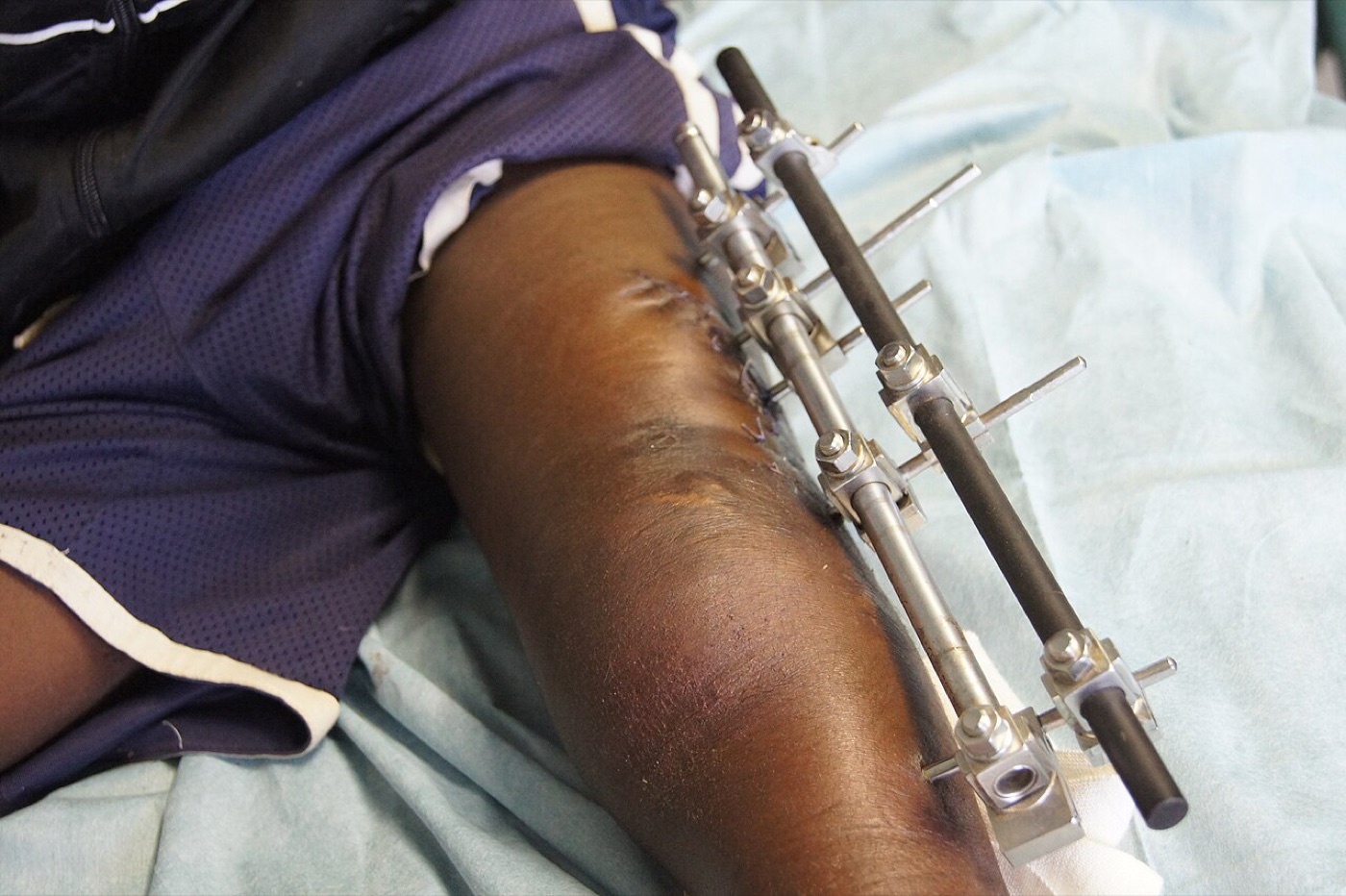 Figure 9. Monolateral external fixator applied to the femur, used for damage control and temporary stabilisation. Image by Ortopedikus, CC BY-SA 4.0, via Wikimedia Commons.