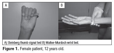 Marfan systemic signs on real clinical photographs: (A) the Steinberg thumb sign and (B) the Walker-Murdoch wrist sign. (Cipriano et al., via Wikimedia Commons; CC BY 4.0.)