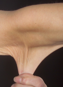 Skin hyperextensibility in Ehlers-Danlos syndrome: the forearm skin lifts away abnormally far when pinched. (Whitaker et al., PMC3504533, Wikimedia Commons; CC BY 2.5.)