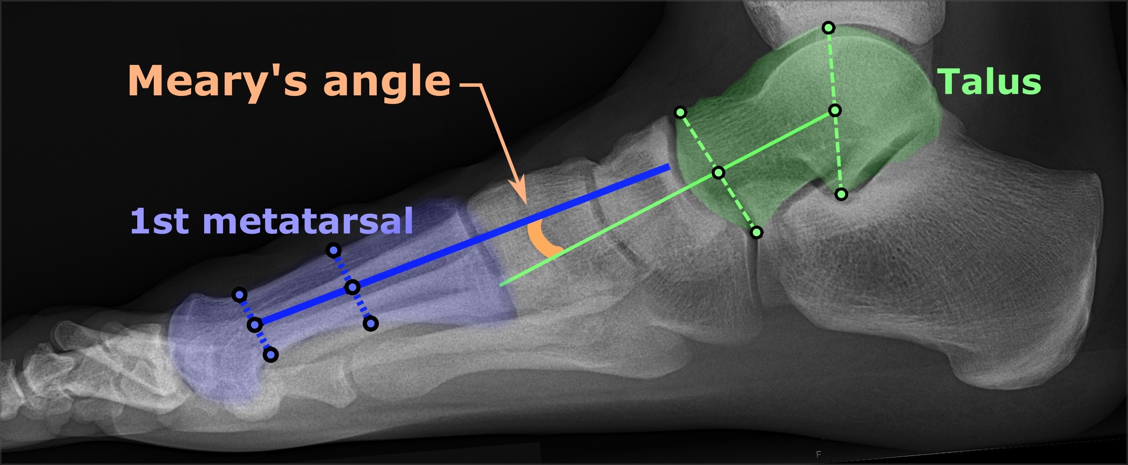 Measurement of the lateral talo-first-metatarsal (Meary) angle on a weight-bearing radiograph of a normal foot - the talar and first-metatarsal axes are normally colinear; the angle breaks (apex plantar) in a flatfoot. (Mikael Häggström, Wikimedia Commons; CC0.)