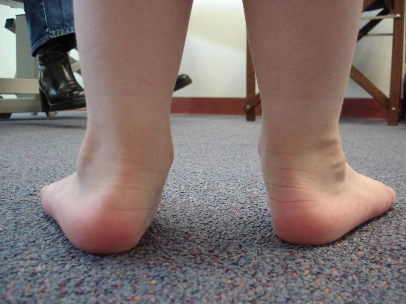 Standing posterior (rear) view of a child with flexible flatfoot: bilateral hindfoot (heel) valgus. (FA RenLis, Wikimedia Commons; CC BY-SA 3.0.)