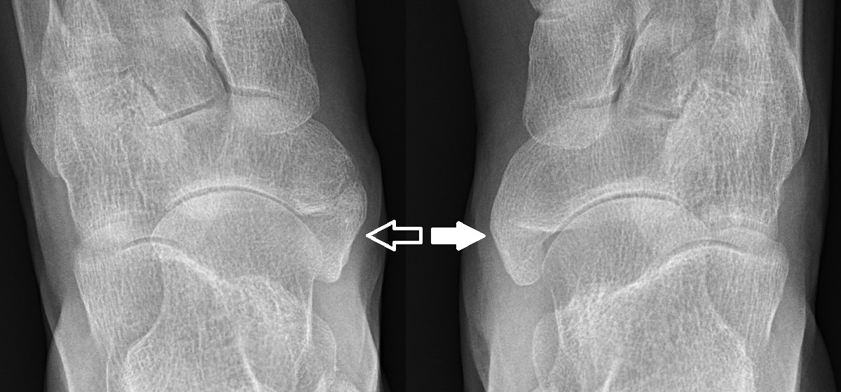 Dorsoplantar radiograph of both feet: a separate accessory navicular ossicle (one foot) and a cornuate navicular (other foot), arrowed. (Mikael Häggström, Wikimedia Commons; CC0.)