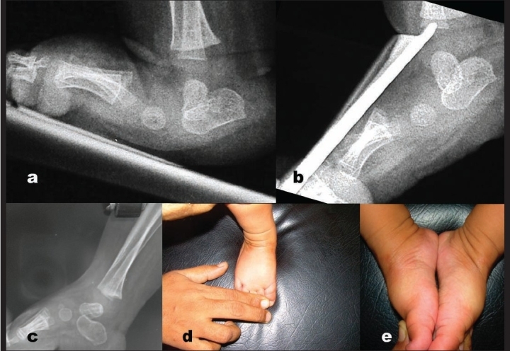 Congenital vertical talus in an infant: (a) lateral radiograph with a vertical, plantar-flexed talus and talonavicular dislocation; (b) the forced-plantarflexion stress lateral showing the talus stays vertical (fixed dislocation); (c) post-correction film; (d, e) clinical images. (Mahajan et al., Indian J Orthop 2008; CC BY.)