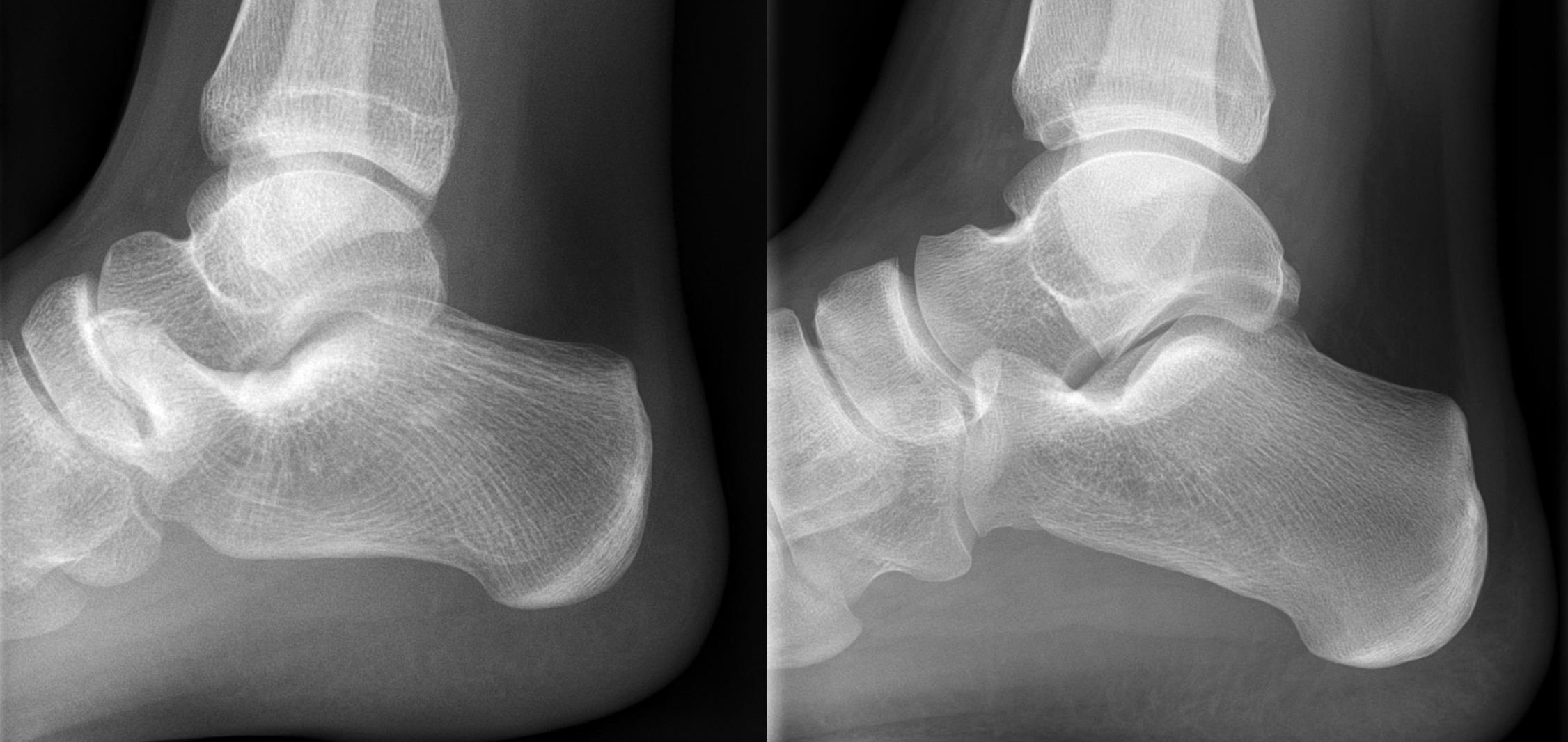Calcaneonavicular coalition: the affected side (left) shows an elongated anterior calcaneal process - the “anteater nose” sign - compared with the normal side. (Hellerhoff, Wikimedia Commons; CC BY-SA 3.0.)