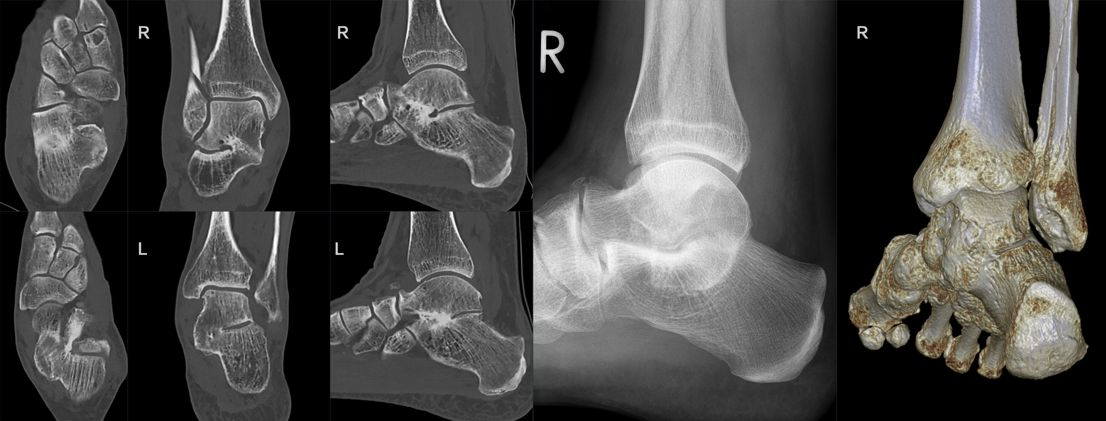 Bilateral talocalcaneal (middle-facet) coalition on CT: coronal and sagittal reconstructions, a lateral radiograph and a 3-D rendering show the bony bridge at the sustentaculum tali. (Hellerhoff, Wikimedia Commons; CC BY-SA 4.0.)