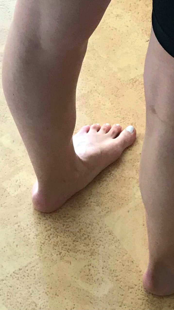 Clinical appearance of an adult acquired flatfoot: the medial longitudinal arch has collapsed to the floor. (AnnaAndersson00, Wikimedia Commons; CC0.)