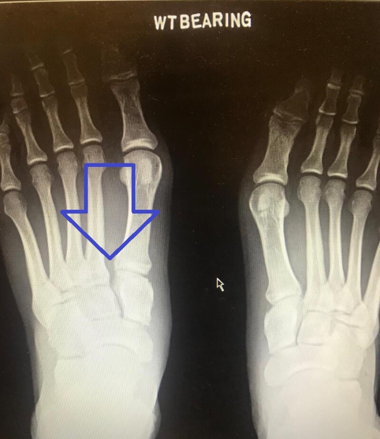 Figure 11. Bilateral weight-bearing radiographs showing subtle diastasis of the left first-second intermetatarsal space from a Lisfranc ligament rupture; comparison with the normal side is the diagnostic key. Mark A. Dreyer, DPM, CC BY 4.0, via Wikimedia Commons.