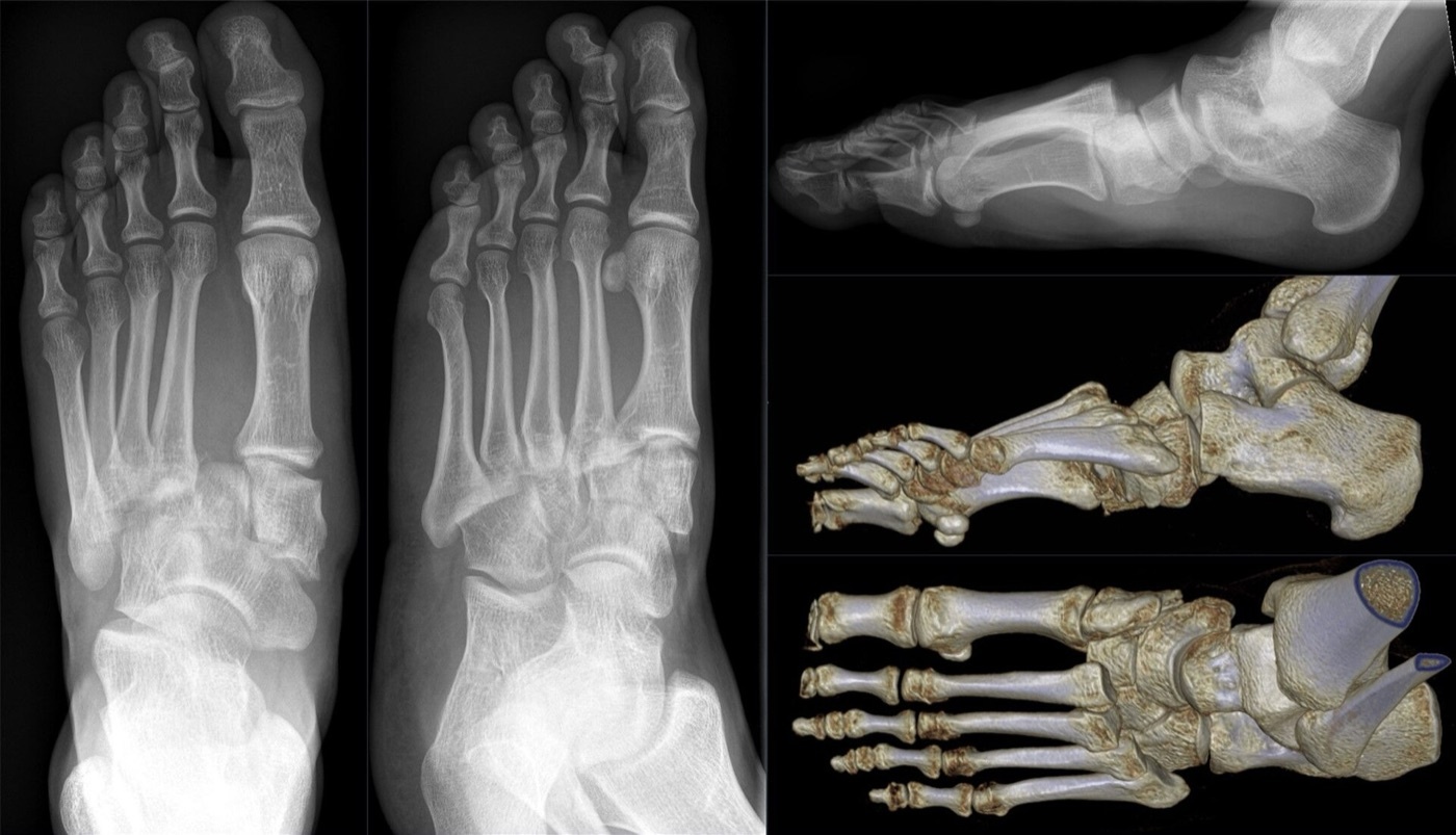 Figure 12. Lisfranc fracture-dislocation with lateral displacement of the lesser metatarsals, shown on radiographs and three-dimensional CT reconstruction. Hellerhoff, CC BY-SA 4.0, via Wikimedia Commons.