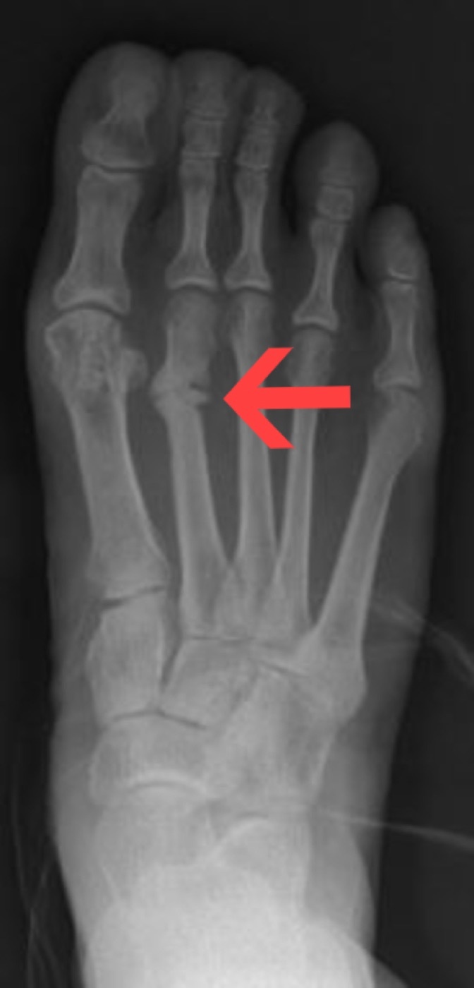 Figure 13. Healing stress (march) fracture of the second metatarsal shaft with periosteal callus (arrow); stress fractures favour the relatively immobile second and third rays. Personalo, CC BY-SA 3.0, via Wikimedia Commons.