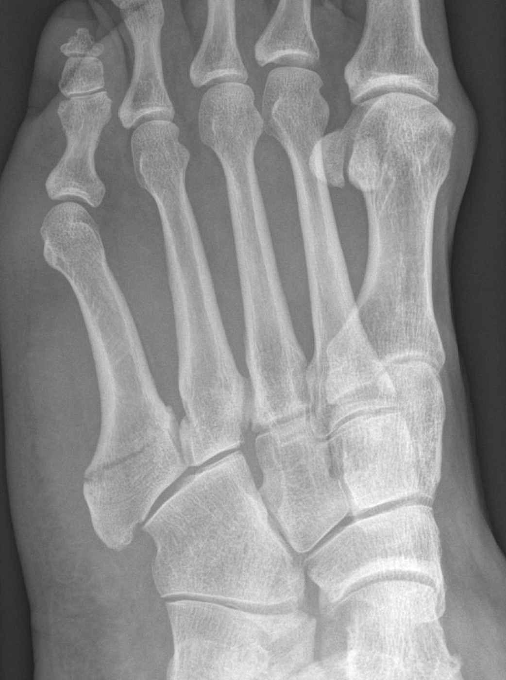 Figure 14. Oblique radiograph of a true Jones fracture at the metaphyseal-diaphyseal junction of the fifth metatarsal, a watershed region prone to nonunion. Hellerhoff, CC BY-SA 4.0, via Wikimedia Commons.
