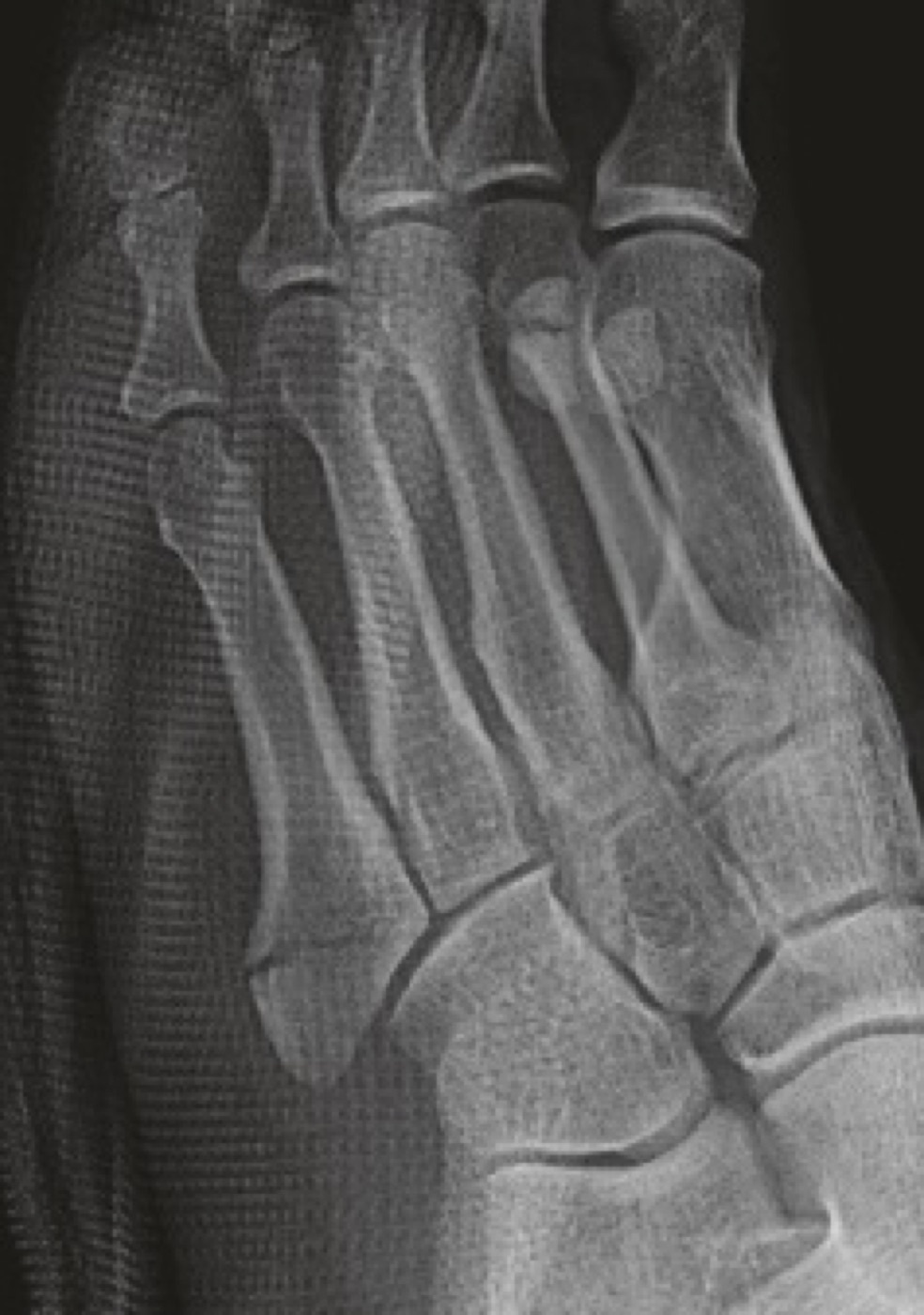 Figure 15. Fracture of the proximal fifth metatarsal at the border between the metaphysis and the tuberosity. Park et al., CC BY 4.0, via Wikimedia Commons.
