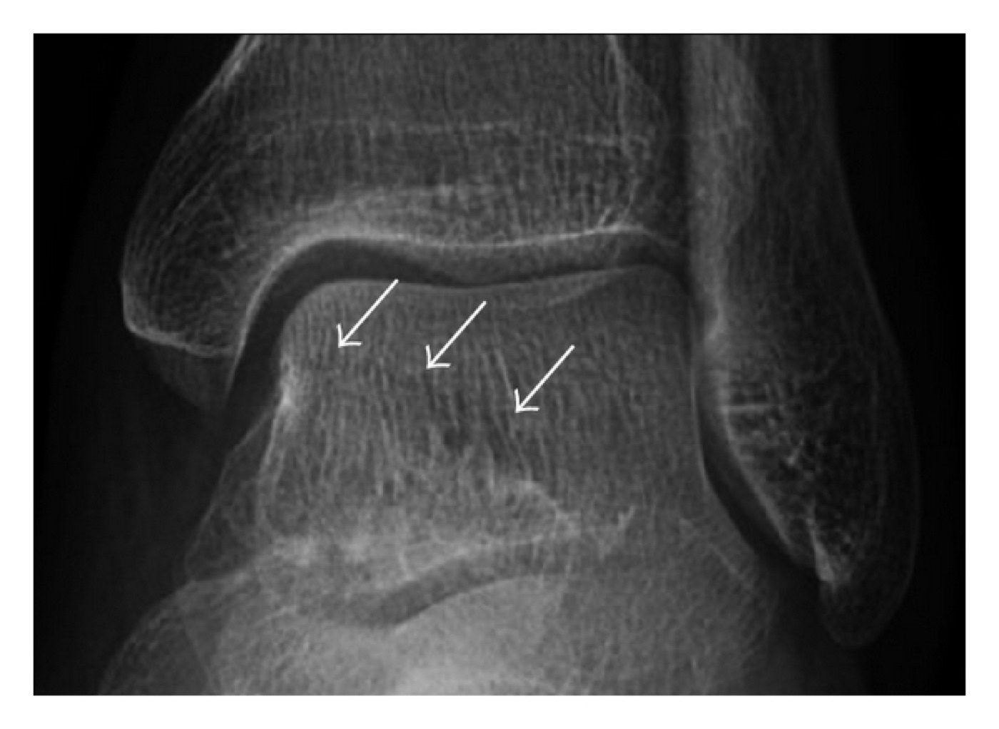 Figure 3. A talar fracture that is subtle on the plain radiograph (arrows); talar fractures are easily missed and frequently need CT for confirmation. Jarraya et al., CC BY 3.0, via Wikimedia Commons.