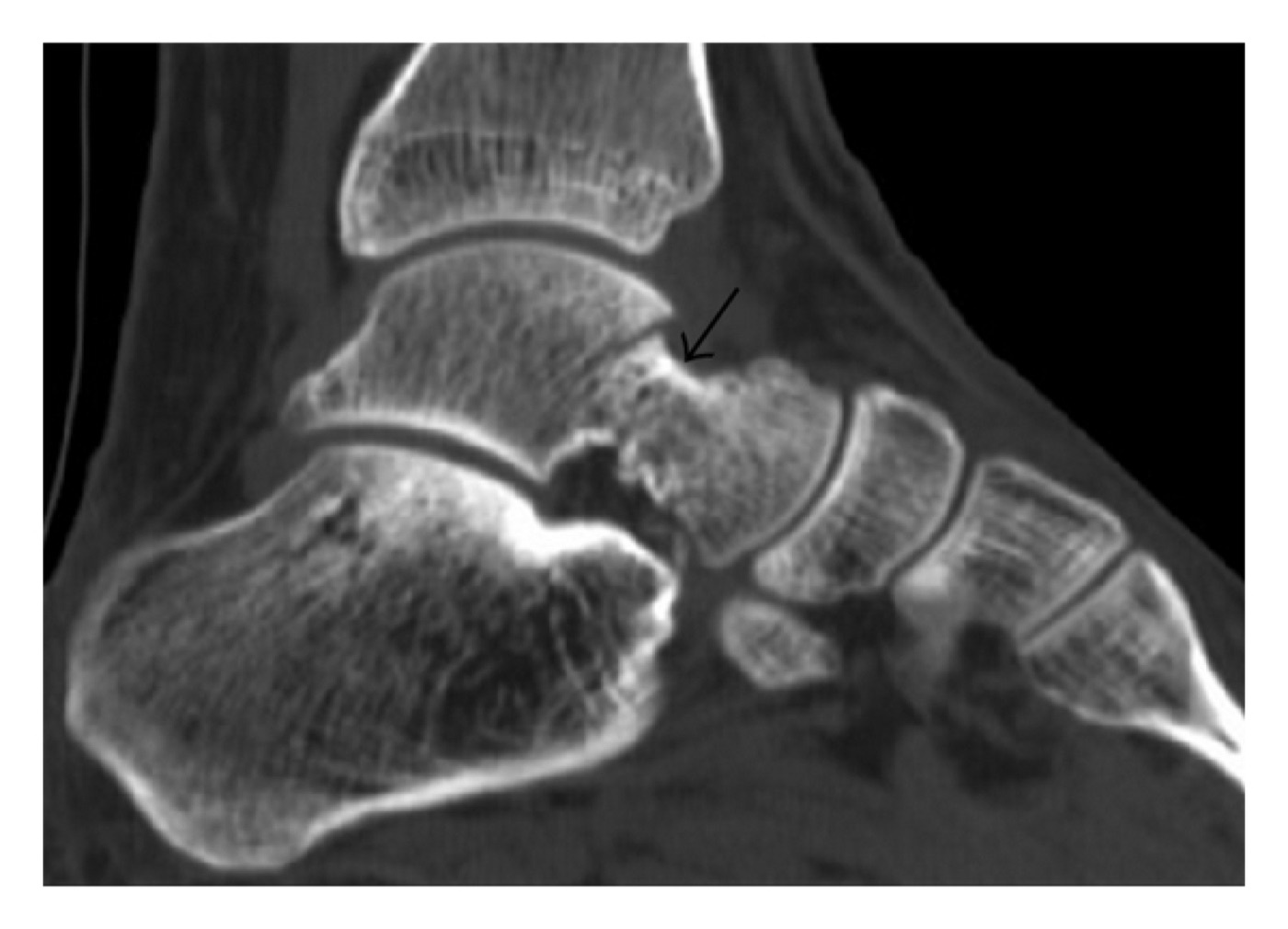 Figure 4. The same talar fracture confirmed on sagittal CT (arrow), which is routine for characterising talar injuries and planning fixation. Jarraya et al., CC BY 3.0, via Wikimedia Commons.