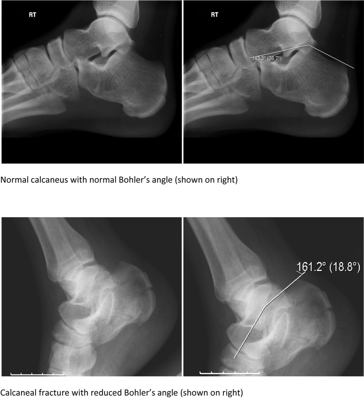 Figure 5. Böhler’s tuber-joint angle on the lateral view: a normal calcaneus (top) compared with a calcaneal fracture in which the angle is flattened by depression of the posterior facet (bottom). Gilo1969, CC BY-SA 3.0, via Wikimedia Commons.