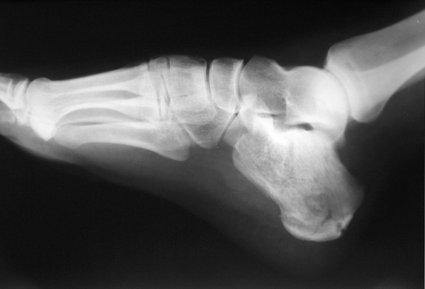 Figure 6. Lateral radiograph of a calcaneal fracture with a depressed posterior facet after a fall from height. Jojo, CC BY-SA 3.0, via Wikimedia Commons.