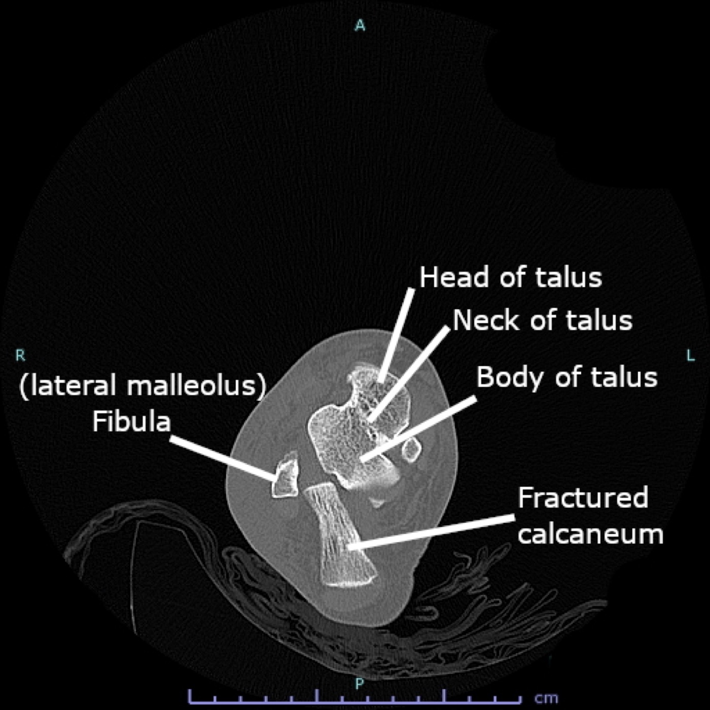 Figure 7. Axial CT of a comminuted calcaneal fracture (the Sanders classification is built on the coronal reformat through the posterior facet). Cerevisae, CC BY-SA 4.0, via Wikimedia Commons.