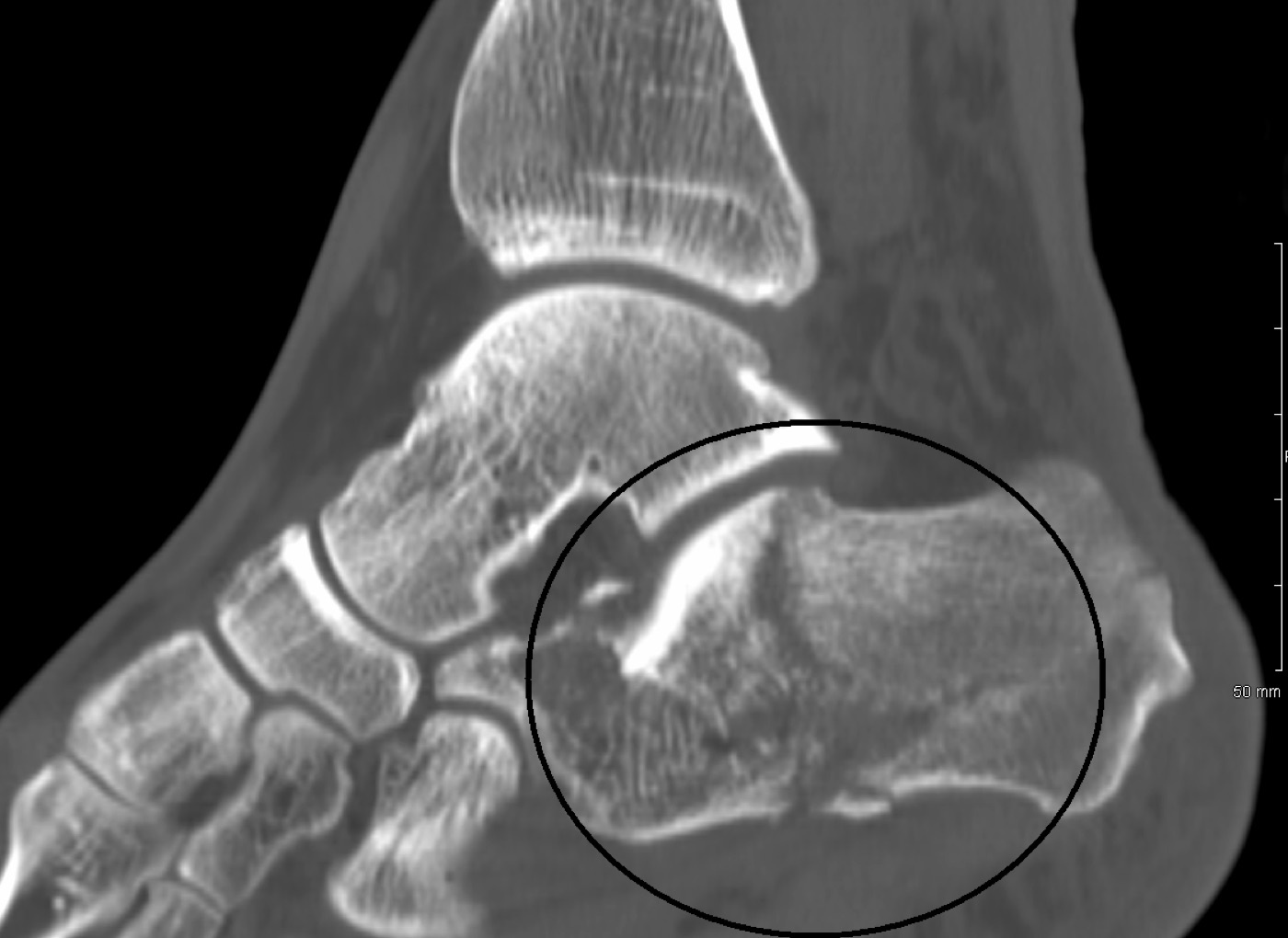 Figure 8. Sagittal CT of a fractured calcaneus (circled), profiling the posterior-facet depression and the tuberosity. James Heilman, MD, CC BY-SA 3.0, via Wikimedia Commons.