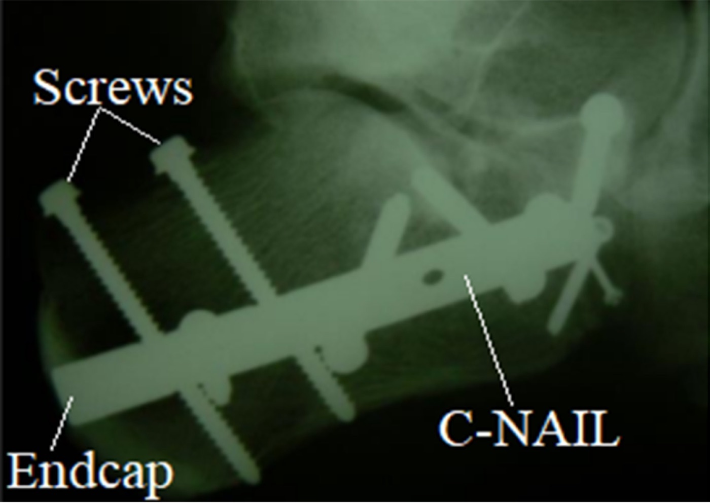 Figure 9. Calcaneal fracture after osteosynthesis with a minimally invasive intraosseous nail (C-Nail) and screws, an alternative to extensile-approach lateral plating that reduces the wound-complication risk. Fry72, CC BY-SA 4.0, via Wikimedia Commons.