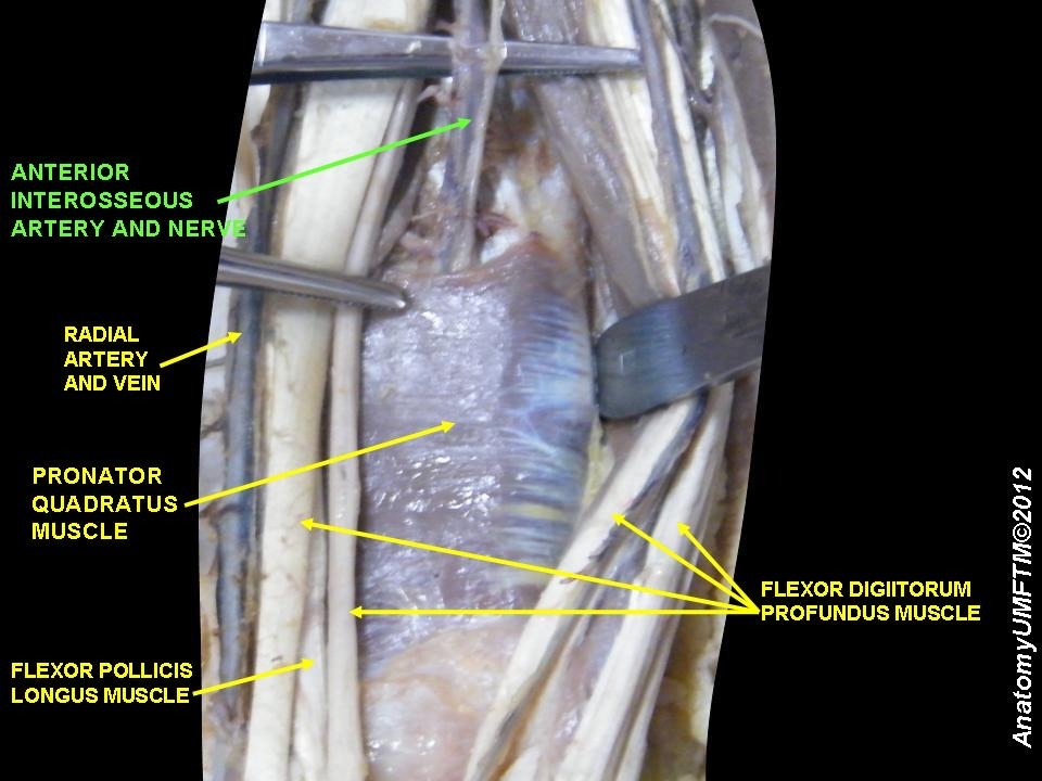 Figure 18. Deep flexor compartment, cadaveric dissection: flexor digitorum profundus, flexor pollicis longus and pronator quadratus, with the anterior interosseous neurovascular bundle on the interosseous membrane. Anatomist90, CC BY-SA 3.0, via Wikimedia Commons.