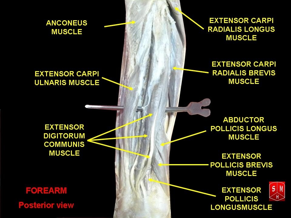 Figure 21. Posterior (extensor) compartment of the forearm, cadaveric dissection: the superficial and deep extensors including the extensor carpi radialis longus/brevis, extensor digitorum, extensor carpi ulnaris, anconeus and the outcropping thumb muscles. Anatomist90, CC BY-SA 3.0, via Wikimedia Commons.