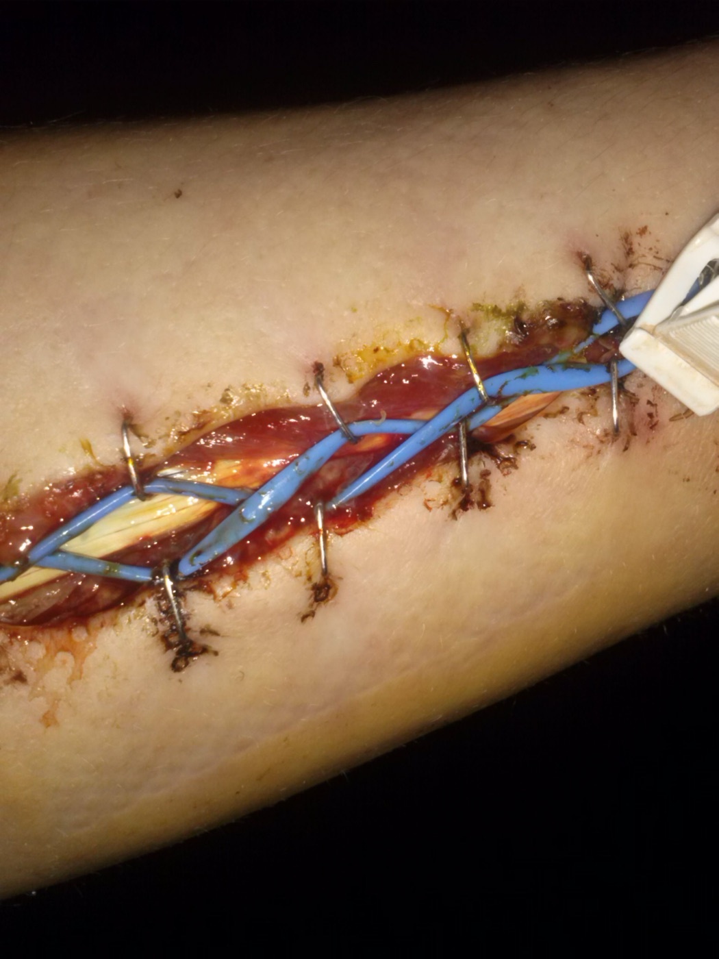 Figure 22. Forearm fasciotomy for compartment syndrome, managed with a vessel-loop “shoelace” closure to allow gradual delayed skin approximation. TPompert, CC BY-SA 4.0, via Wikimedia Commons.