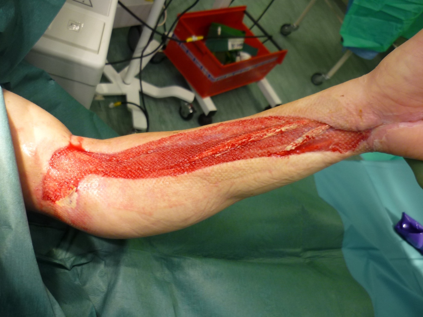 Figure 23. Open forearm fasciotomy wound (granulating) prior to split-skin grafting. Guyprocter, released under CC0, via Wikimedia Commons.