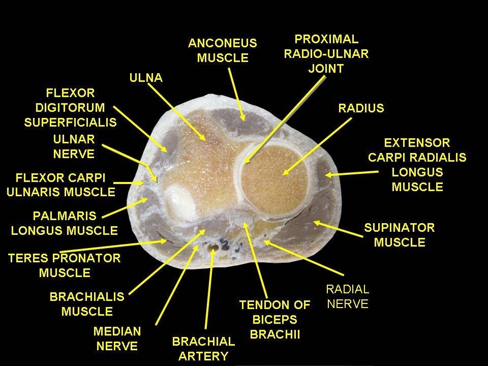 Figure 3. Cadaveric cross-section of the proximal forearm: the flexor and extensor muscle groups around the radius and ulna, with the median, ulnar and radial nerves and the brachial artery. Anatomist90, CC BY-SA 3.0, via Wikimedia Commons.