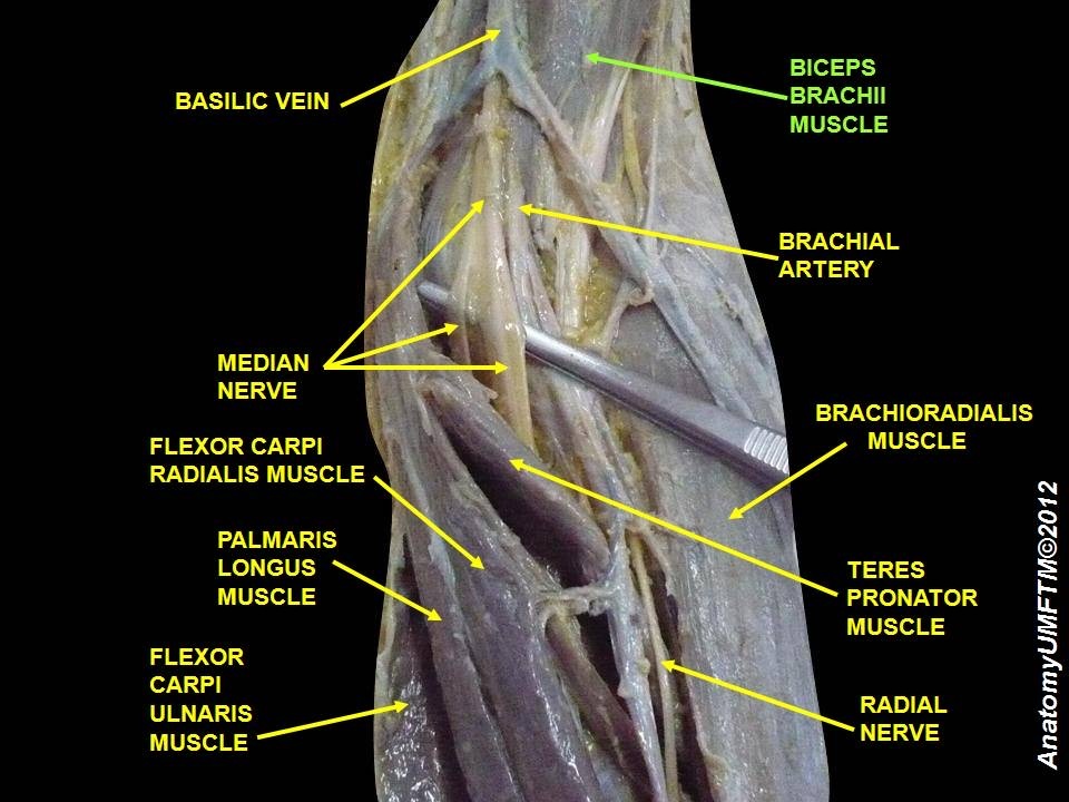 Figure 7. Anterior forearm / cubital fossa dissection: the median nerve and brachial artery entering the forearm between the heads of pronator teres, with the superficial flexors and brachioradialis. Anatomist90, CC BY-SA 3.0, via Wikimedia Commons.
