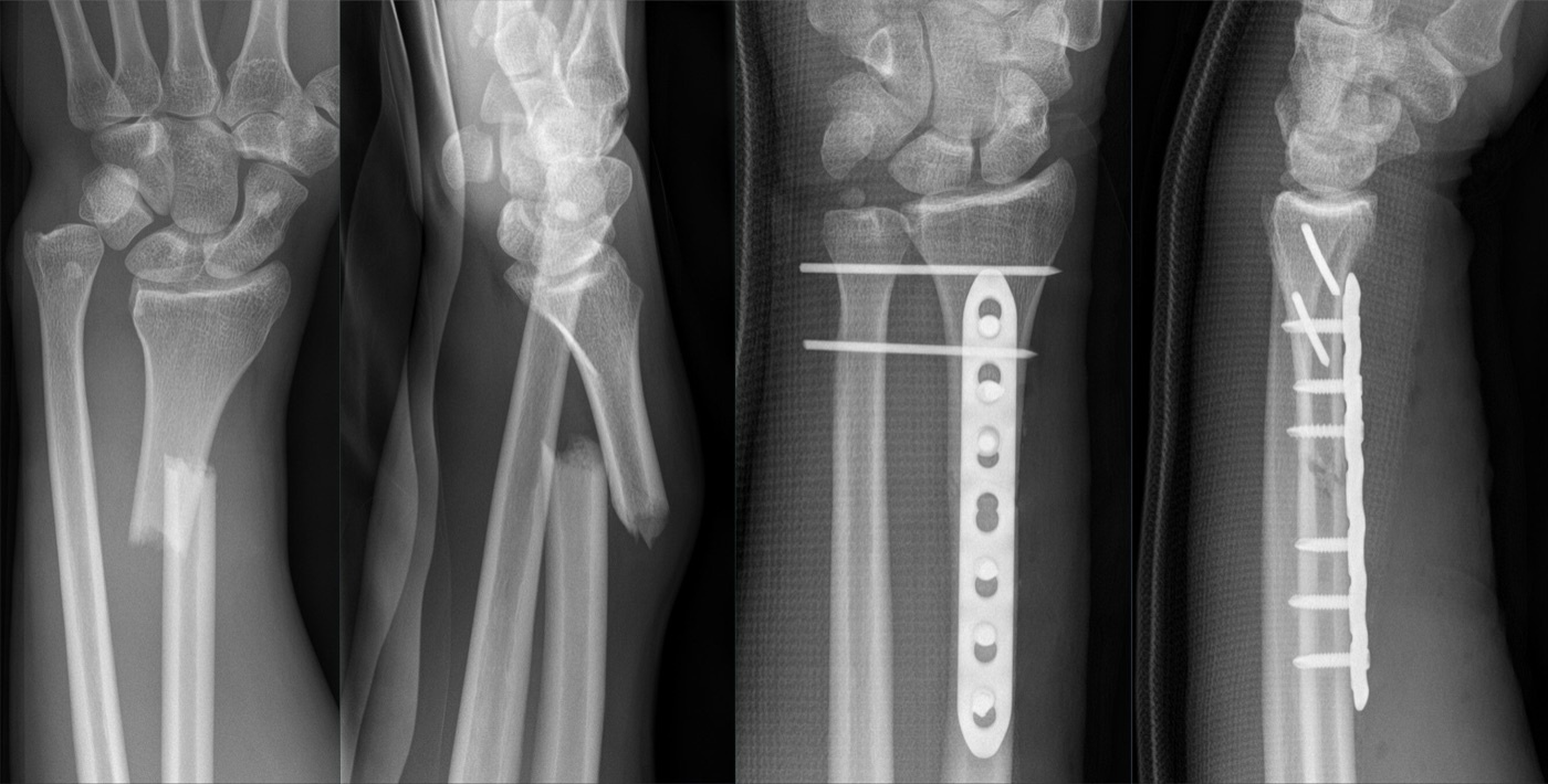 Figure 12. Galeazzi fracture (radial shaft fracture with distal radio-ulnar joint disruption) before and after open reduction and internal fixation of the radius with a volar plate. Hellerhoff, CC BY-SA 4.0, via Wikimedia Commons.