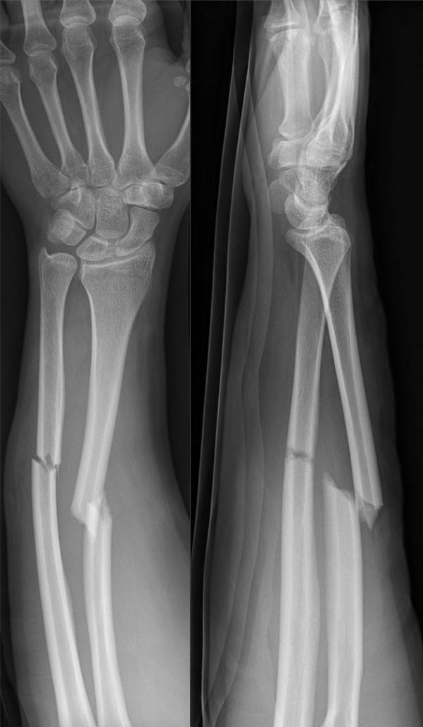 Figure 13. Displaced radial shaft fracture of the forearm from direct trauma, AP and lateral views. Hellerhoff, CC BY-SA 4.0, via Wikimedia Commons.