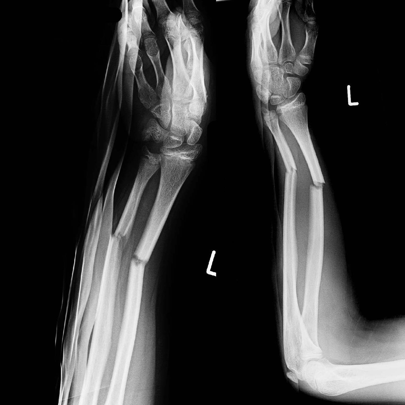Figure 14. Both-bone (radius and ulna) diaphyseal forearm fracture with angulation, AP and lateral views. Thomas Zimmermann, CC BY-SA 3.0 DE, via Wikimedia Commons.