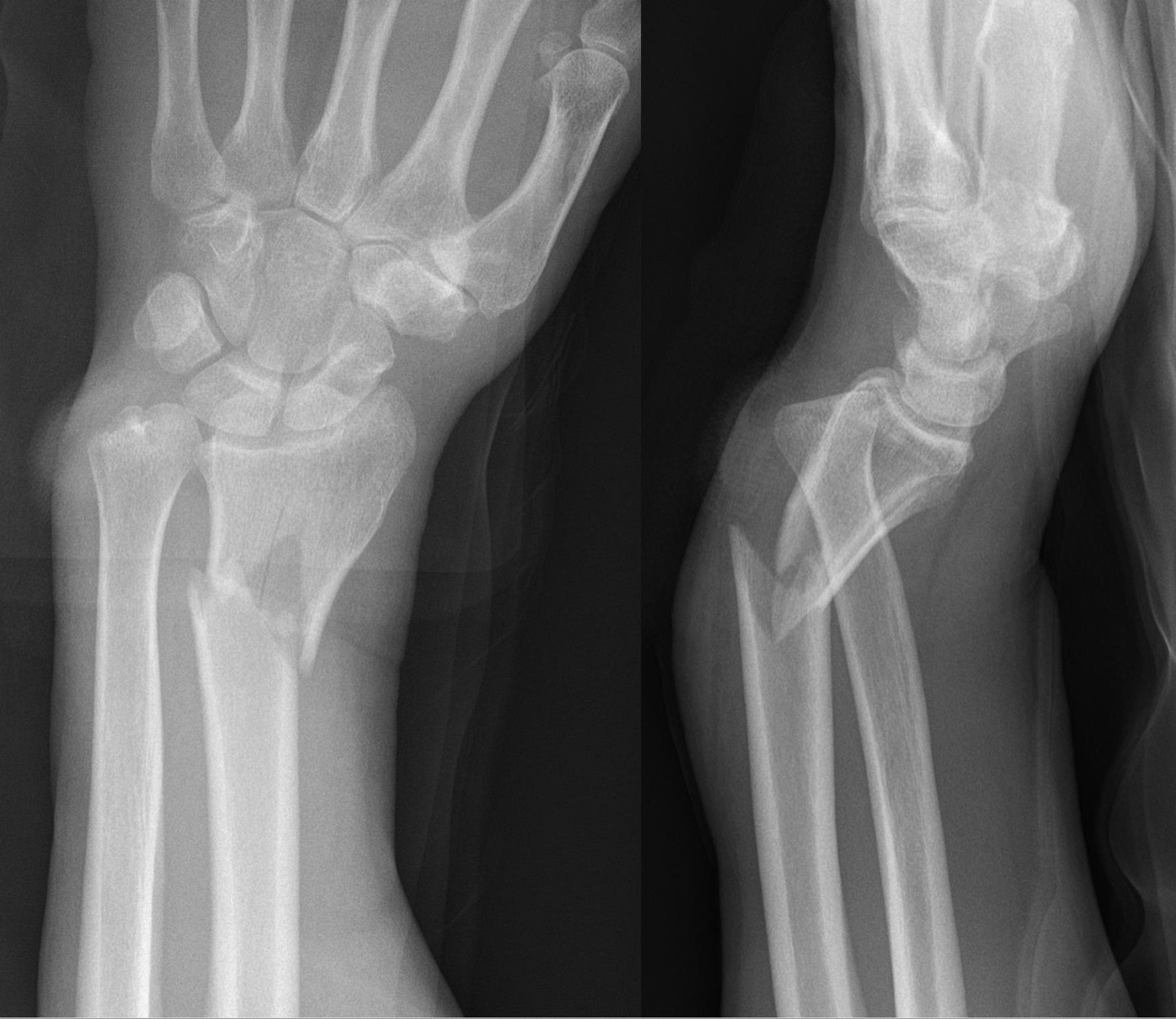 Figure 6. Galeazzi fracture-dislocation: a distal-third radius fracture with disruption of the distal radioulnar joint, AP and lateral radiographs. Hellerhoff, CC BY-SA 3.0, via Wikimedia Commons.