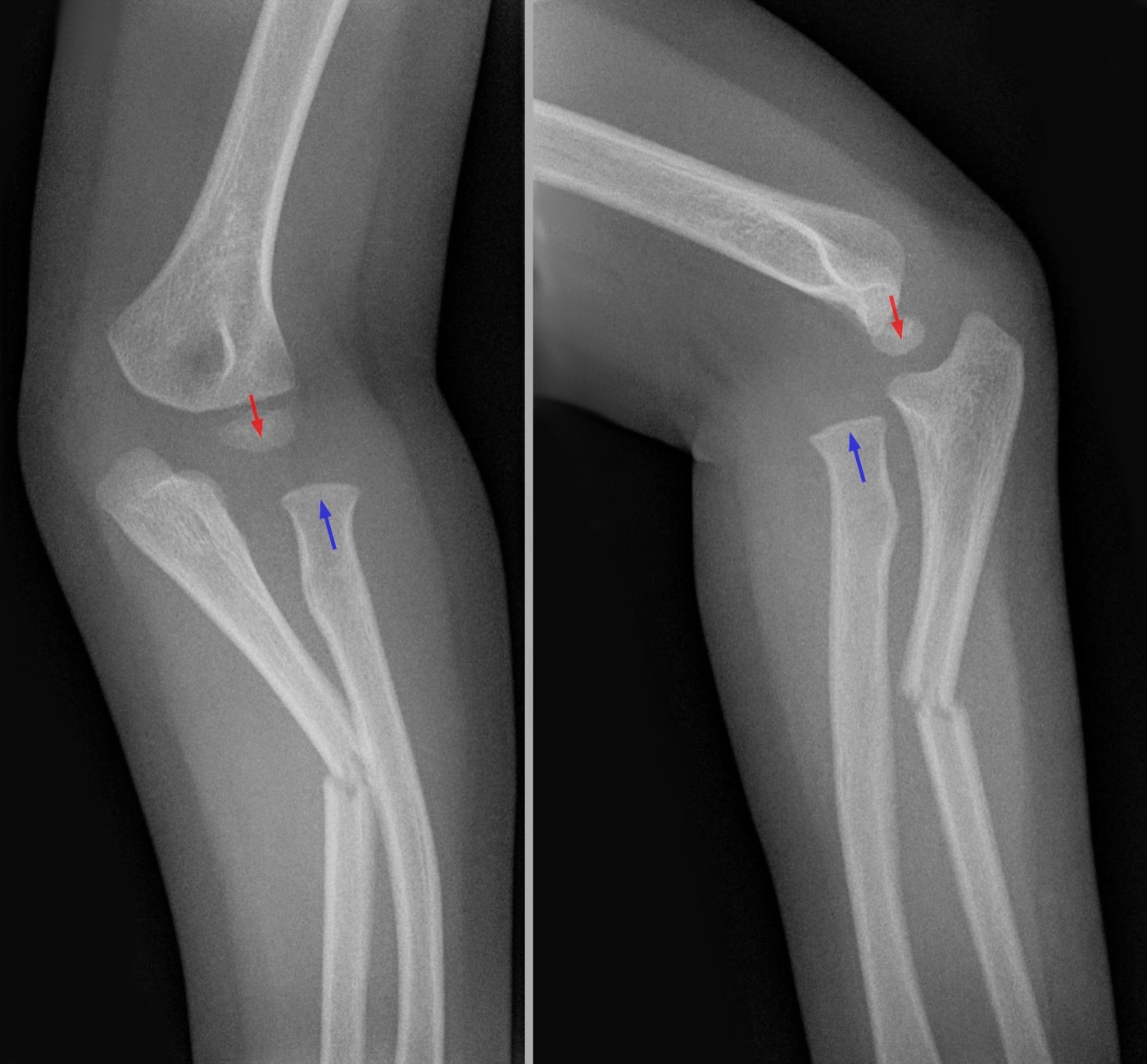 Figure 7. Monteggia fracture-dislocation: a proximal ulna fracture (blue arrow) with dislocation of the radial head (red arrow), AP and lateral radiographs. Hellerhoff, CC BY-SA 3.0, via Wikimedia Commons.