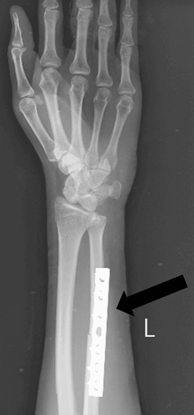 Figure 8. Isolated ulnar shaft (“nightstick”) fracture, here shown after plate fixation of a displaced fracture; the radius is intact. Ambekar et al., Cureus 2024;16(1):e53353, CC BY 4.0.