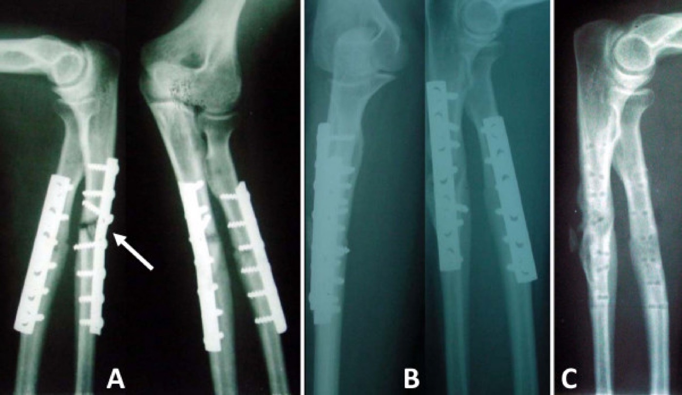 Figure 12. Diaphyseal forearm nonunion (ulnar shaft, arrow) and its revision by compression plating and bone grafting. Dos Reis et al., Ann Surg Innov Res 2009;3:5, CC BY 2.0.