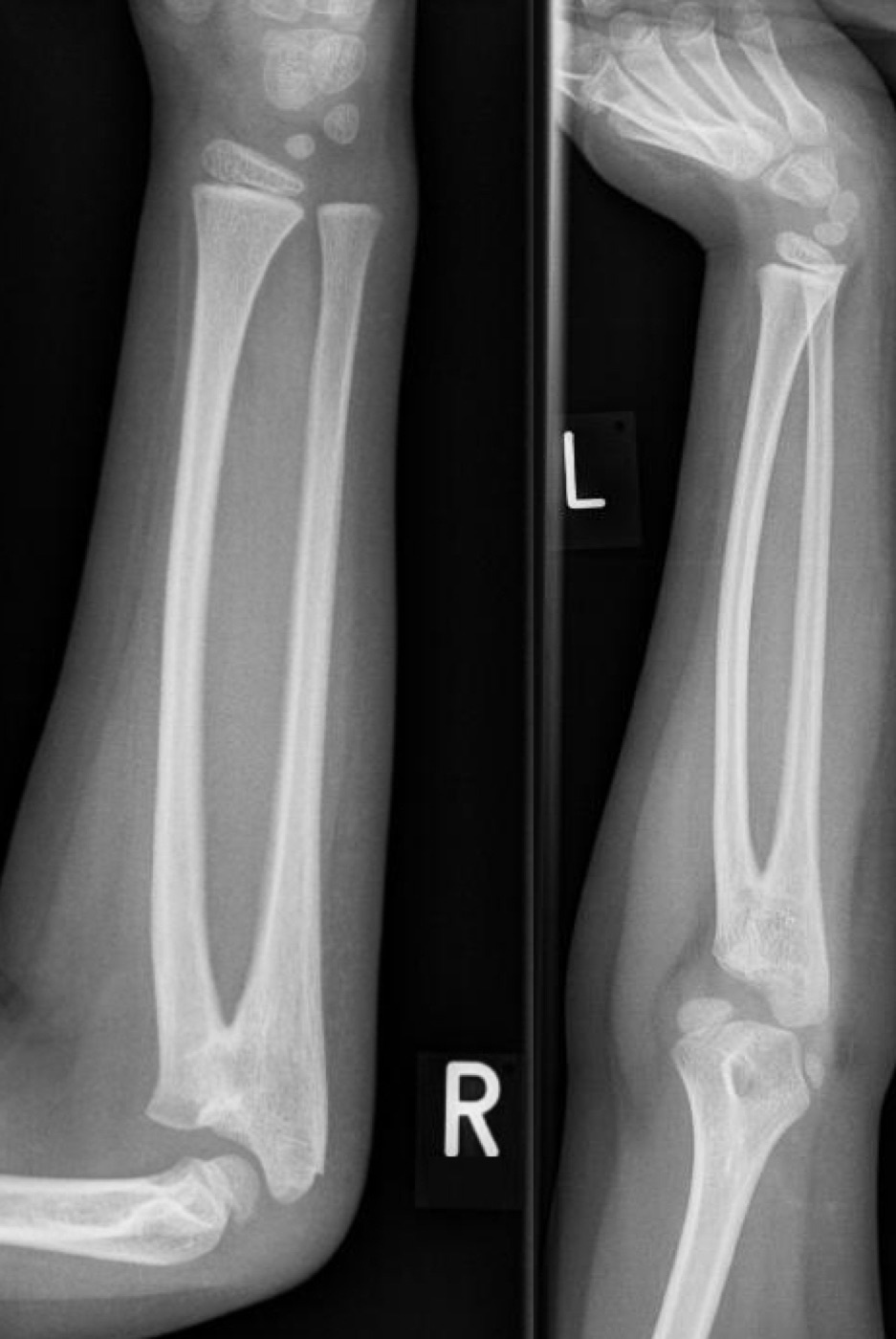 Figure 13. Radioulnar synostosis: a bony bridge (cross-union) between the radius and the ulna that abolishes forearm rotation. This example is a congenital cross-union; the bony-bridge morphology is the same as that of the post-traumatic complication. Kinderradiologie Olgahospital, Klinikum Stuttgart, CC BY-SA 3.0, via Wikimedia Commons.