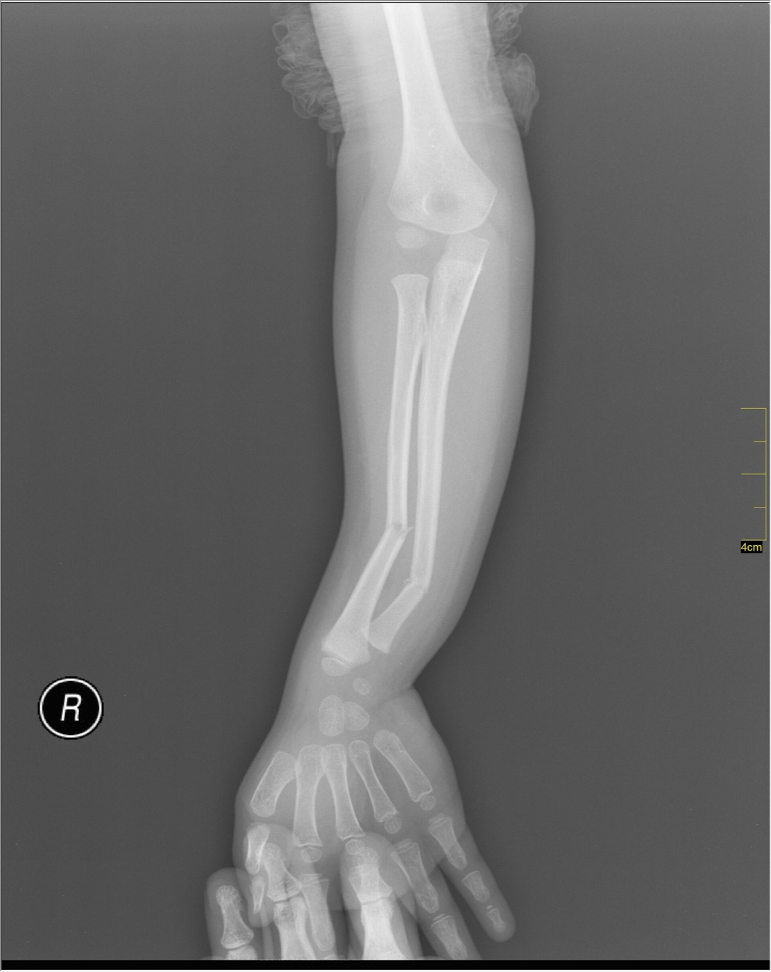 Figure 1. A displaced both-bone diaphyseal fracture of the radius and ulna (a paediatric example: four-fifths of forearm-shaft fractures occur in children). Nevit Dilmen, CC BY-SA 3.0, via Wikimedia Commons.