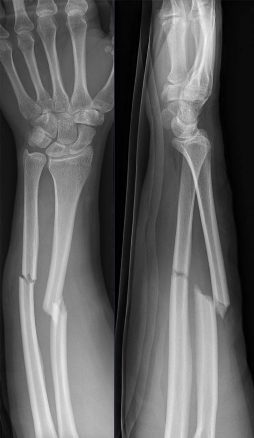 Figure 2. A displaced both-bone forearm-shaft fracture in a young adult from direct, high-energy trauma, AP and lateral radiographs. Hellerhoff, CC BY-SA 4.0, via Wikimedia Commons.