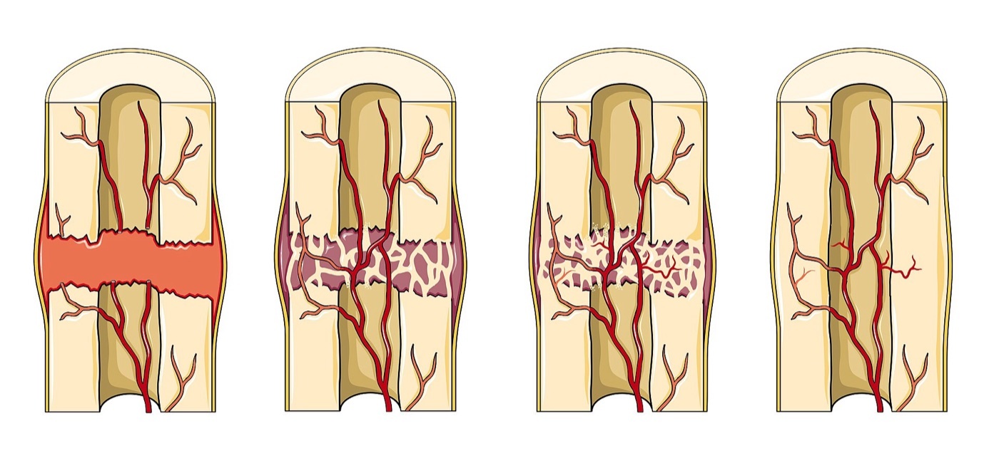 Figure 1. Secondary fracture healing: haematoma → soft (cartilaginous) callus → hard (bony) callus → remodelled bone, with the periosteal and endosteal blood supply. Source: Laboratoires Servier (Servier Medical Art), via Wikimedia Commons, CC BY-SA 3.0.