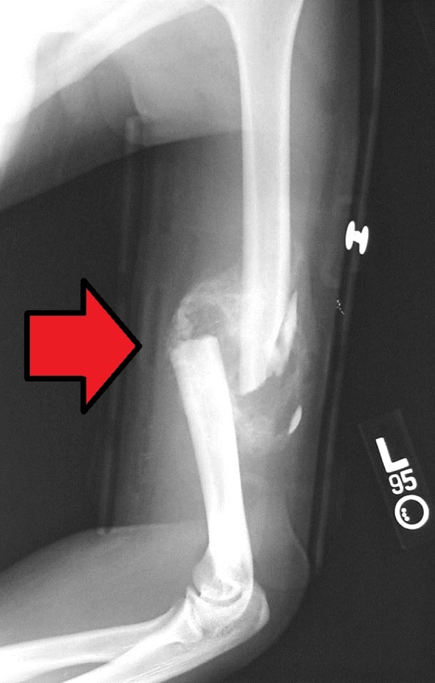 Figure 4. Bridging callus around a healing comminuted humeral shaft fracture (arrow). Source: Bill Rhodes, via Wikimedia Commons, CC BY 2.0.