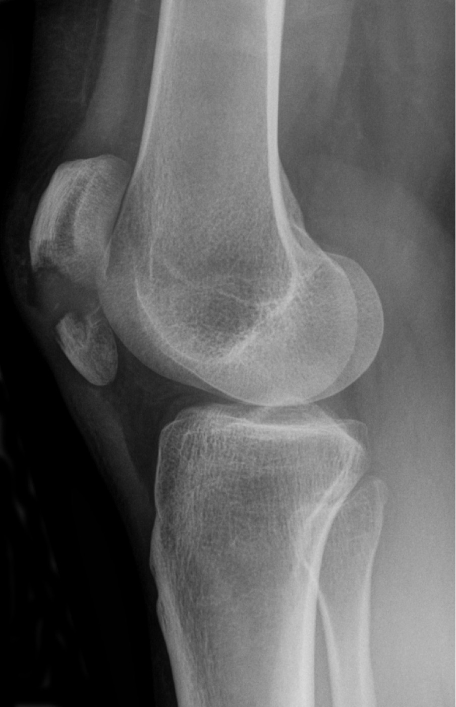 Figure 5. Transverse fracture of the patella (tension/avulsion mechanism). Source: Hellerhoff, via Wikimedia Commons, CC BY-SA 3.0.