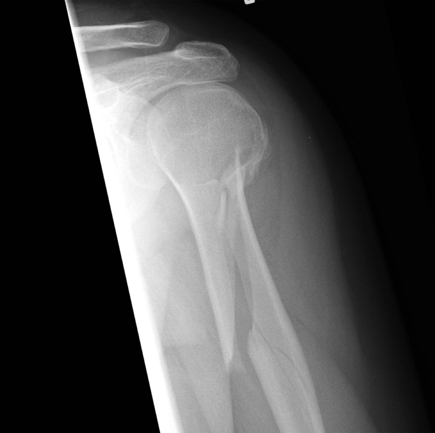 Figure 6. Spiral fracture of the humeral shaft (torsional mechanism). Source: RSJThompson, via Wikimedia Commons, CC BY-SA 3.0.